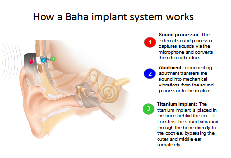 BAHA Overview